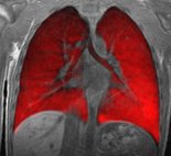 An MRI image of the lungs with inhaled hyperpolarized xenon gas.